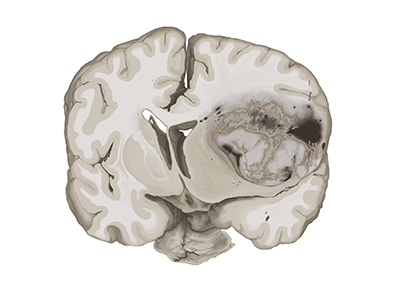 Brain and back pathology